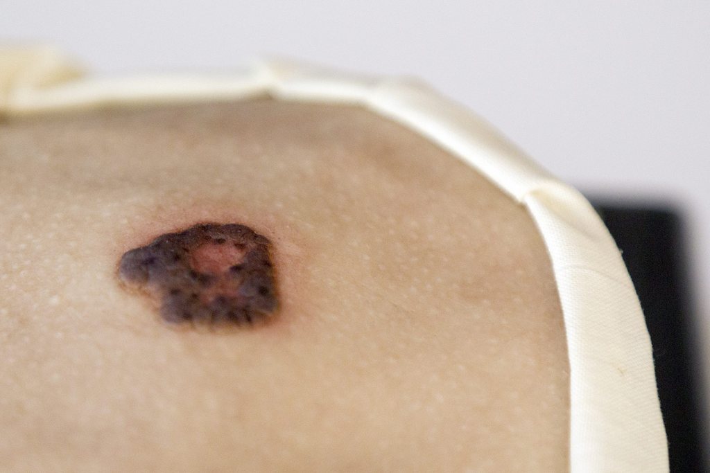 Les Suisses sont proportionnellement plus touchés par le cancer de la peau que leurs voisins européens.